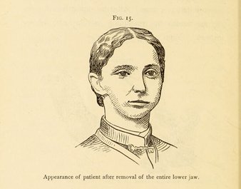 Medical illustration of a young woman. The right side of her face is sunken.